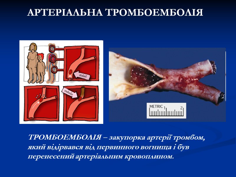 АРТЕРІАЛЬНА ТРОМБОЕМБОЛІЯ ТРОМБОЕМБОЛІЯ – закупорка артерії тромбом, який відірвався від первинного вогнища АРТЕРІАЛЬНА ТРОМБОЕМБОЛІЯ ТРОМБОЕМБОЛІЯ – закупорка артерії тромбом, який відірвався від первинного вогнища